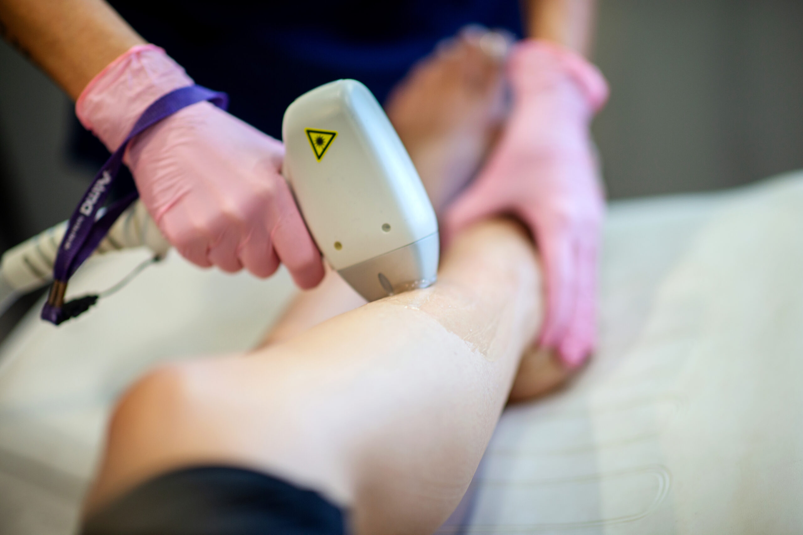 Laser vein treatment performed at Seiff Center for spider and varicose veins