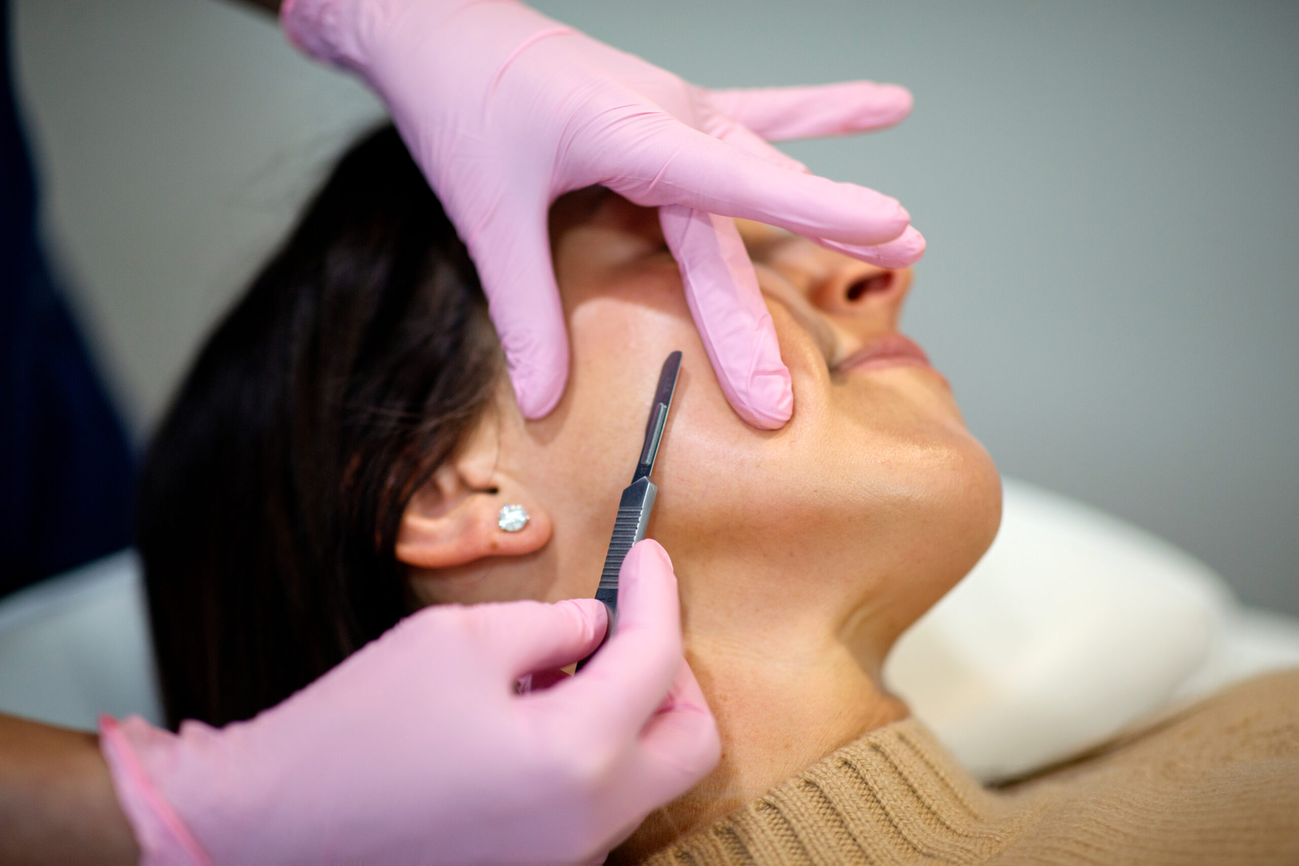 Dermaplaning session removing dead skin cells at Seiff Center medispa