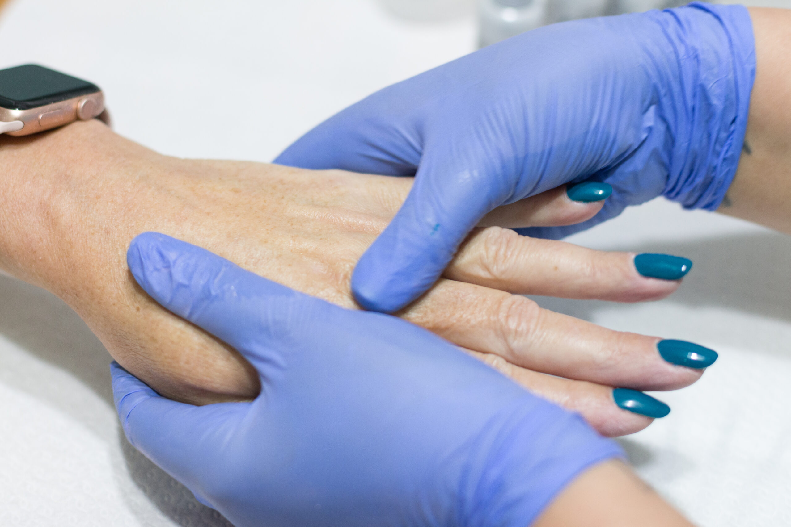 a person's hand with a painted fingernail receiving spider vein examination